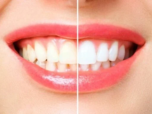 Sobre Branqueamento dentário