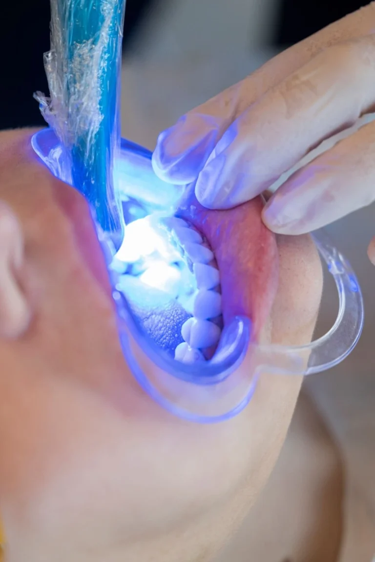 branqueamento dentário