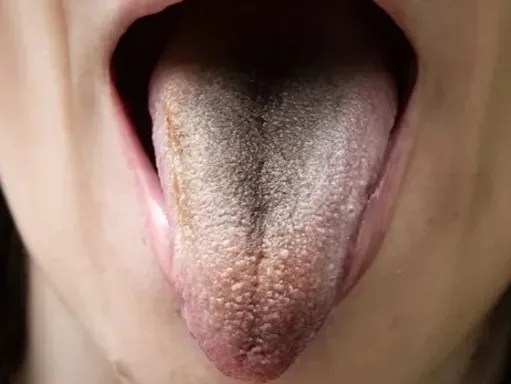 língua pilosa
