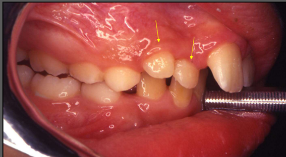 dentes supranumerários