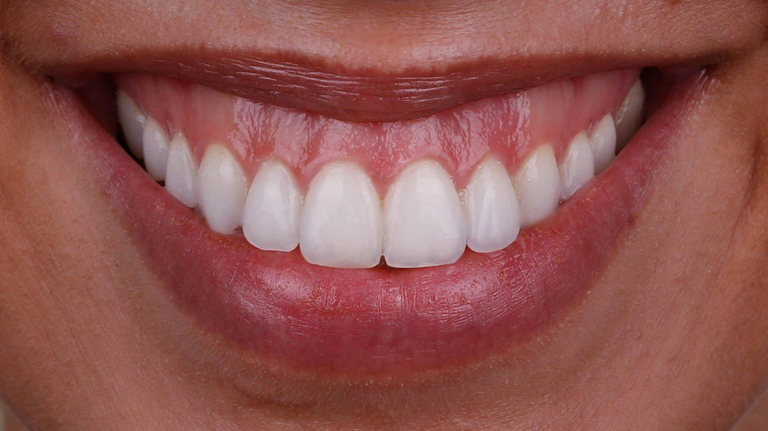 Sorriso Gengival