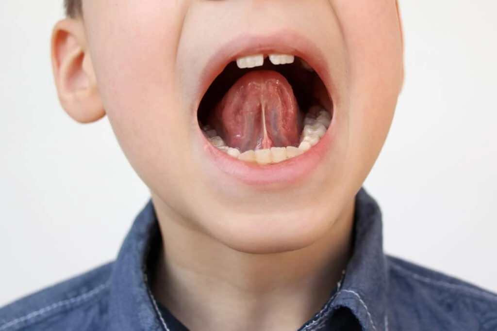 Frenectomia em Odontopediatria