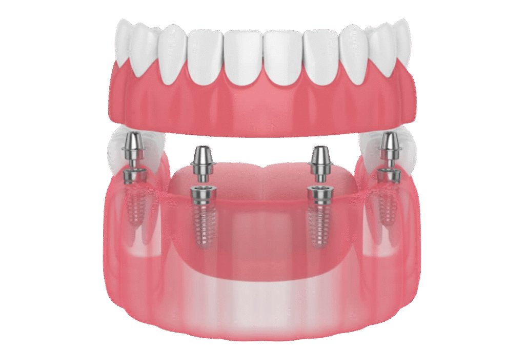 implantes dentários para reabilitação total